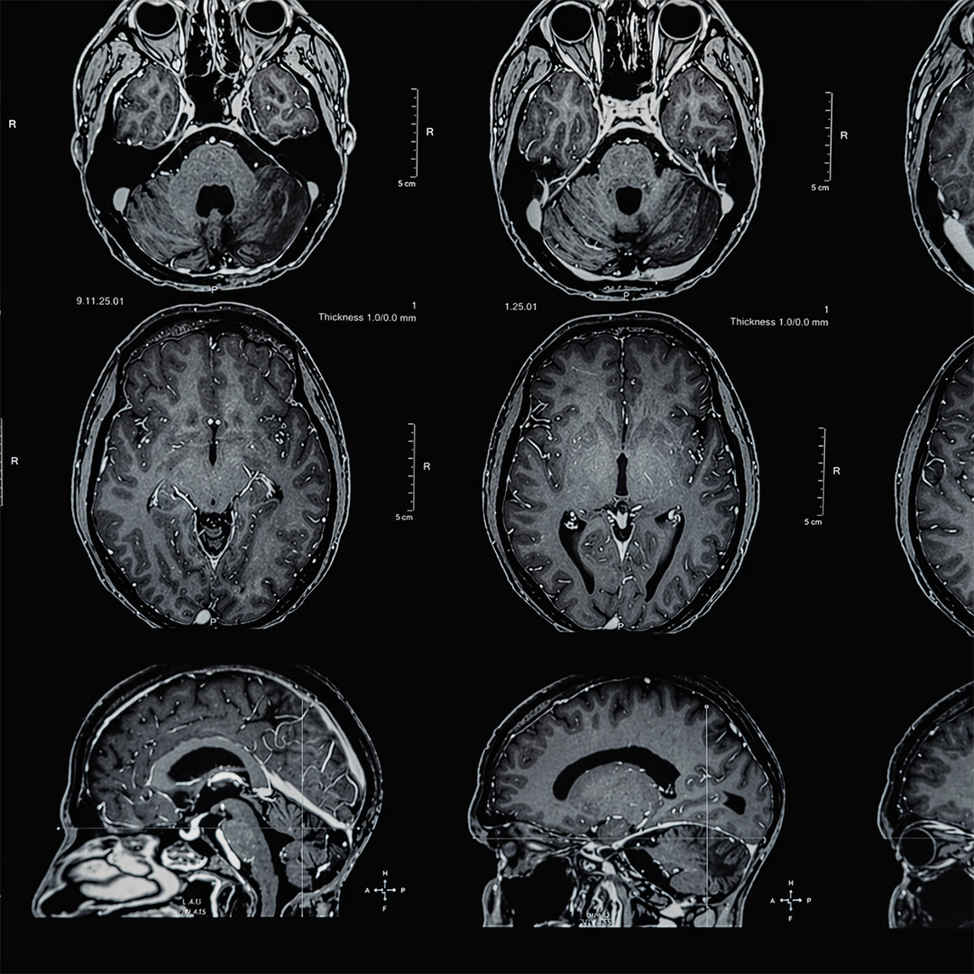 INTERVENTIONAL NEURORADIOLOGY BY DR VIKASH JAIN, RAJKOT, INDIA