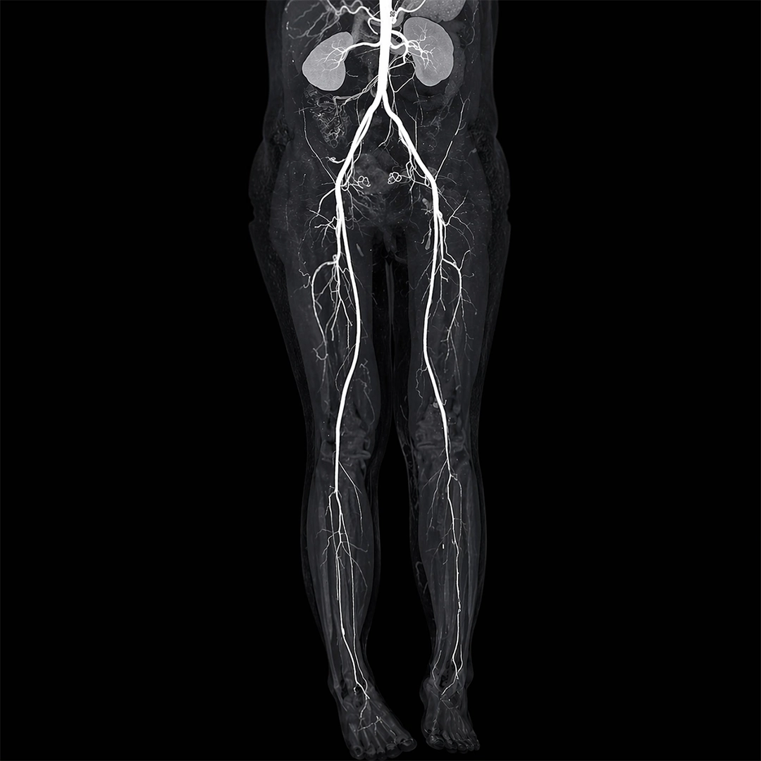 PERIPHERAL VASCULAR INTERVENTIONA BY DR VIKASH JAIN, RAJKOT, INDIA