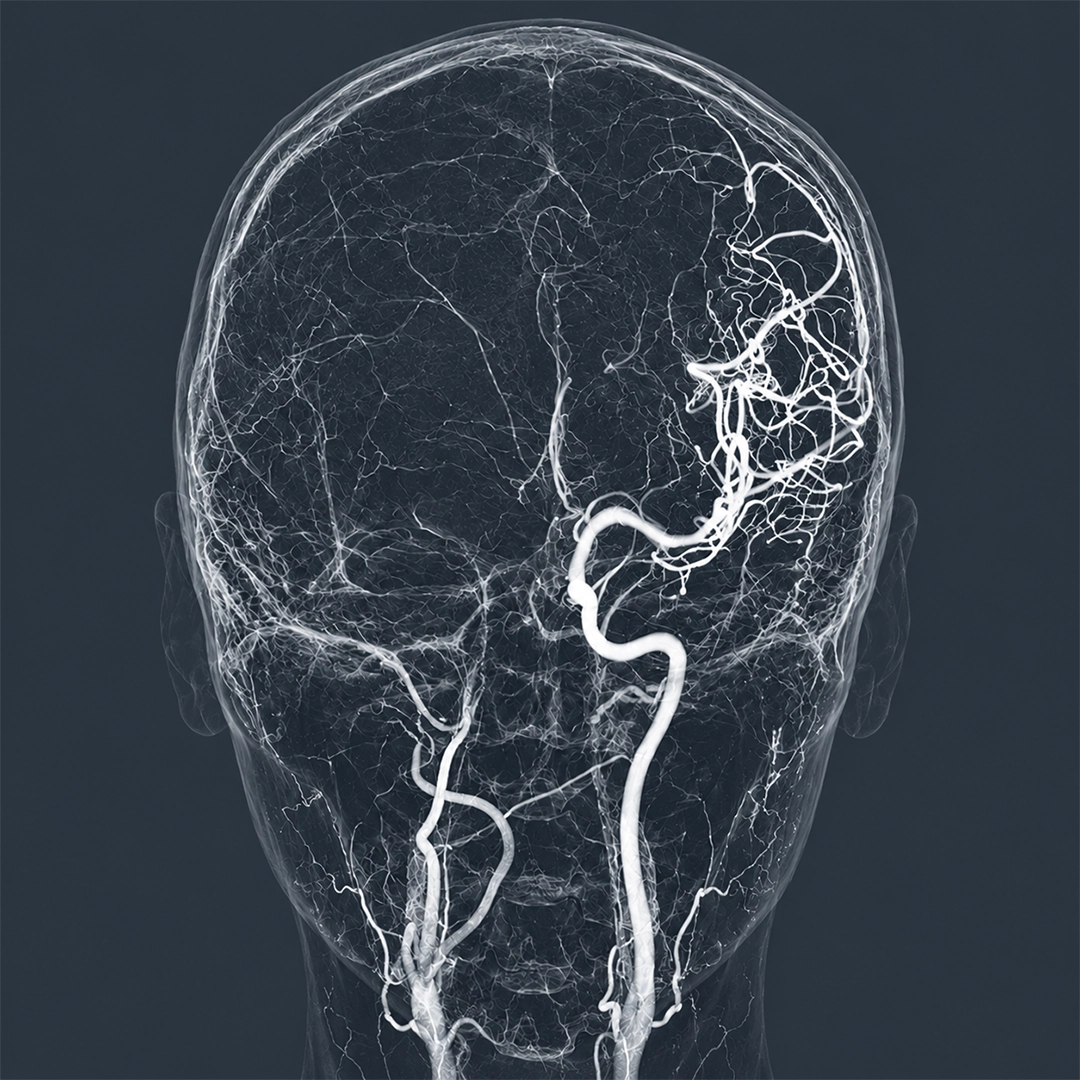 Cerebral Angiography
