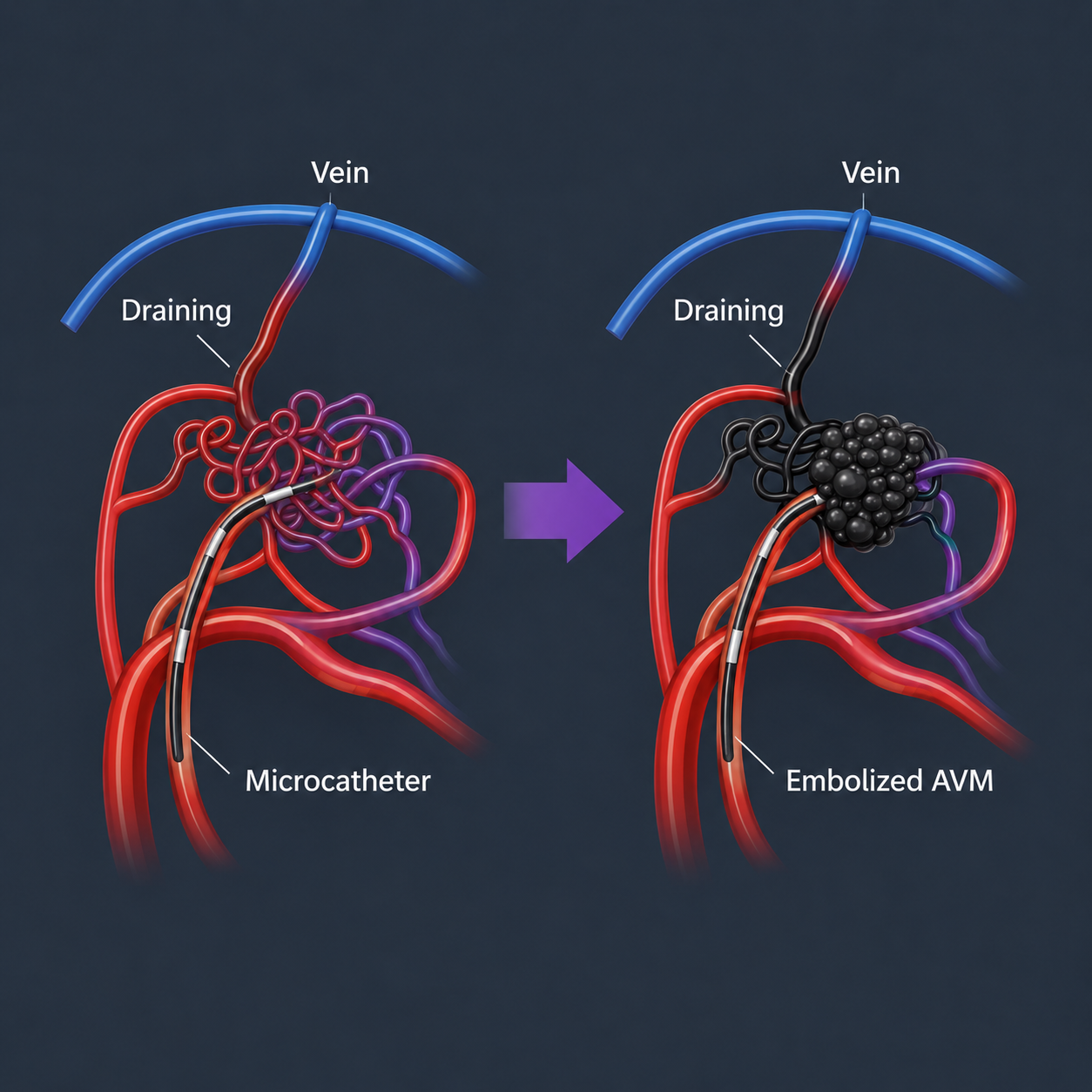 AVM EMBOLIZATION