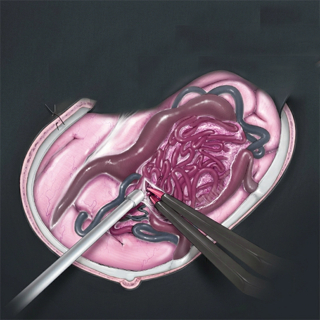 Microsurgical Excision For AVM
